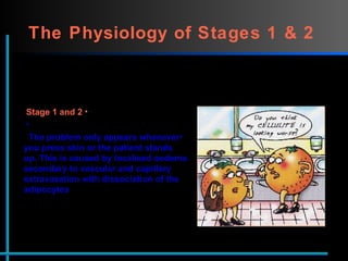 The Physiology of Stages 1 & 2   Stage 1 and 2  The problem only appears whenever  you press skin or the patient stands up. This is caused by localised oedema secondary to vascular and capillary extravasation with dissociation of the adipocytes 