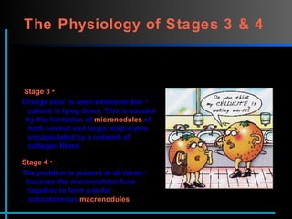 The Physiology of Stages 3 & 4   Stage 3   ‘ Orange skin’ is seen whenever the    patient is lying down. This is caused    by the formation of   micronodules   of   both normal and larger adipocytes    encapsulated by a network of    collagen fibres   Stage 4   The problem is present at all times    because the micronodules fuse    together to form painful    subcutaneous   macronodules .   