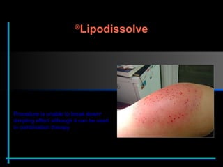 Procedure is unable to break down dimpling effect although it can be used in combination therapy Lipodissolve ® 