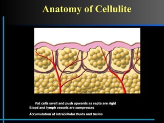 Anatomy of Cellulite Fat cells swell and push upwards as septa are rigid Blood and lymph vessels are compresses   Accumulation of intracellular fluids and toxins 