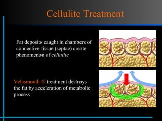 Cellulite Treatment Fat deposits caught in chambers of connective tissue (septae) create  phenomenon of  cellulite Velasmooth ®   treatment destroys the fat by acceleration of metabolic process 