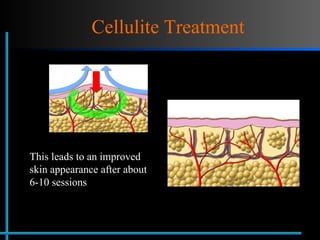 Cellulite Treatment This leads to an improved skin appearance after about 6-10 sessions 