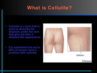 What is Cellulite?   Cellulite is a term that is used to describe fat deposits under the skin that give the skin a dimpled like appearance.  It is estimated that up to 80% of women have a problem with cellulite.  