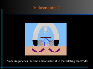 Velasmooth ®  Vacuum pinches the skin and attaches it to the rotating electrodes 