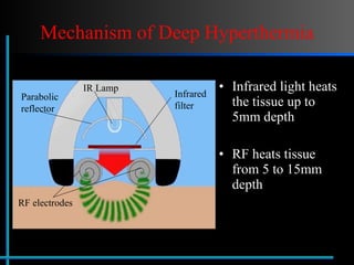 Mechanism of Deep Hyperthermia Infrared light heats the tissue up to 5mm depth RF heats tissue from 5 to 15mm depth IR Lamp Parabolic  reflector Infrared filter RF electrodes 