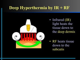 Deep Hyperthermia by IR + RF Infrared  (IR)  light heats the tissue down to the  deep dermis RF  heats tissue down to the  subcutis Lamp Parabolic  reflector Infrared filter RF  electrodes 