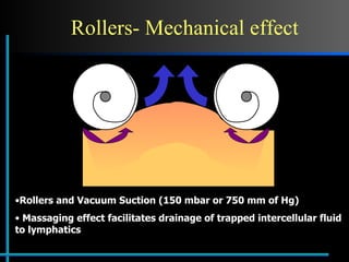 Rollers- Mechanical effect Rollers and Vacuum Suction (150 mbar or 750 mm of Hg) Massaging effect facilitates drainage of trapped intercellular fluid to lymphatics  