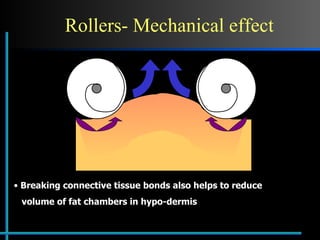 Rollers- Mechanical effect Breaking connective tissue bonds also helps to reduce  volume of fat chambers in hypo-dermis 