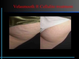 Velasmooth ® Cellulite treatment 