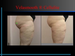 Velasmooth ® Cellulite 