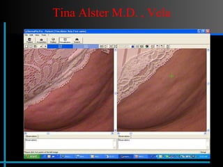 Tina Alster M.D. , Vela 