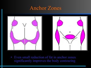 Anchor Zones Even small reduction of fat in anchor zones significantly improves the body contouring  