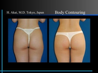 Before After Body Contouring H. Akai, M.D. Tokyo, Japan 