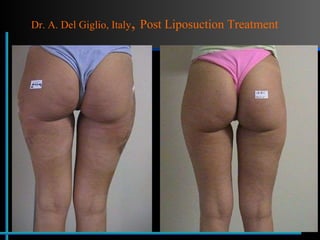 Dr. A. Del Giglio, Italy ,  Post Liposuction Treatment 