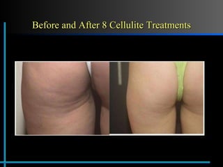 Before and After 8 Cellulite Treatments Before After 
