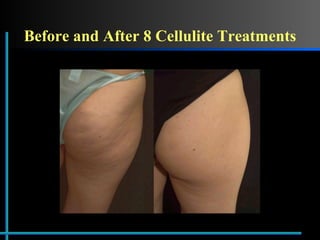Before and After 8 Cellulite Treatments 