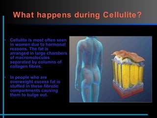 What happens during Cellulite?   Cellulite is most often seen in women due to hormonal reasons. The fat is arranged in large chambers of macromolecules separated by columns of collagen fibres.  In people who are overweight excess fat is stuffed in these  fibrotic  compartments causing them to bulge out.  