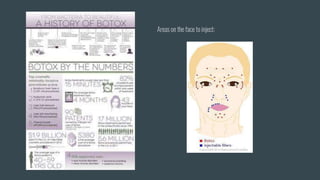 Areas on the face to inject:
 
