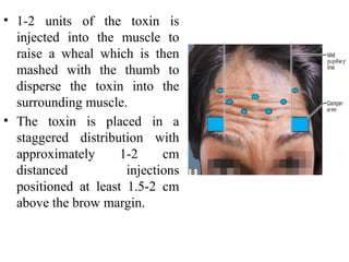 Botox Injection Wheal AESTHETIC USES OF BOTULINUM TOXIN 2.pptx