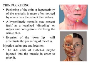 Tear Ridges Dimpling AESTHETIC USES OF BOTULINUM TOXIN 2.pptx