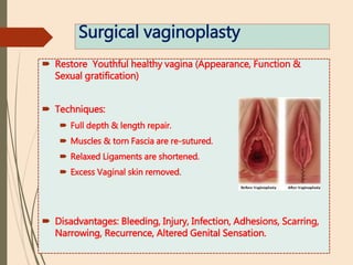 Surgical vaginoplasty
 Restore Youthful healthy vagina (Appearance, Function &
Sexual gratification)
 Techniques:
 Full depth & length repair.
 Muscles & torn Fascia are re-sutured.
 Relaxed Ligaments are shortened.
 Excess Vaginal skin removed.
 Disadvantages: Bleeding, Injury, Infection, Adhesions, Scarring,
Narrowing, Recurrence, Altered Genital Sensation.
 