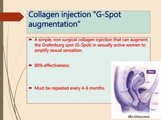 Collagen injection “G-Spot
augmentation”
 A simple, non surgical collagen injection that can augment
the Grafenburg spot (G-Spot) in sexually active women to
amplify sexual sensation.
 80% effectiveness.
 Must be repeated every 4-6 months.
 
