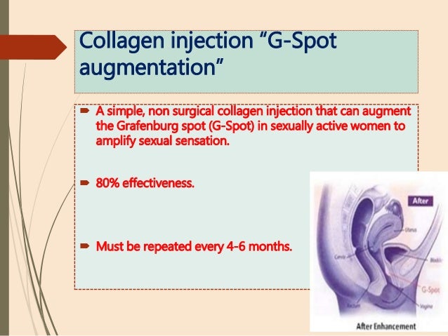 Collagen injection spot g Dangers of