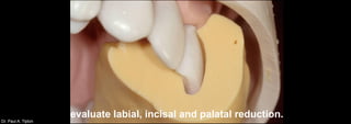 Dr. Paul A. Tipton
evaluate labial, incisal and palatal reduction.
 