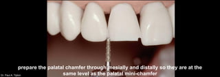 Dr. Paul A. Tipton
prepare the palatal chamfer through mesially and distally so they are at the
same level as the palatal mini-chamfer
 