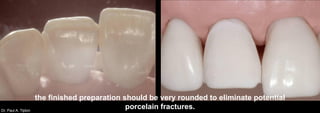 Dr. Paul A. Tipton
the finished preparation should be very rounded to eliminate potential
porcelain fractures.
 