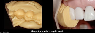 Dr. Paul A. Tipton
the putty matrix is again used.
 