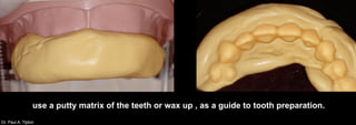 Dr. Paul A. Tipton
use a putty matrix of the teeth or wax up , as a guide to tooth preparation.
 