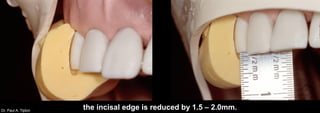 Dr. Paul A. Tipton
the incisal edge is reduced by 1.5 – 2.0mm.
 