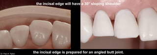 Dr. Paul A. Tipton
the incisal edge is prepared for an angled butt joint.
the incisal edge will have a 30° sloping shoulder
 