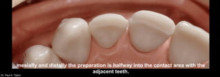 Dr. Paul A. Tipton
mesially and distally the preparation is halfway into the contact area with the
adjacent teeth.
 
