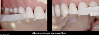 Dr. Paul A. Tipton
all contact areas are smoothed.
 