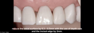 Dr. Paul A. Tipton
reduce the labial surface by 0.3 – 0.5mm with the use of depth cuts
and the incisal edge by 2mm.
 