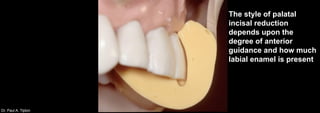 Dr. Paul A. Tipton
The style of palatal
incisal reduction
depends upon the
degree of anterior
guidance and how much
labial enamel is present
 