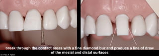 Dr. Paul A. Tipton
break through the contact areas with a fine diamond bur and produce a line of draw
of the mesial and distal surfaces
 