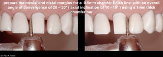 Dr. Paul A. Tipton
prepare the mesial and distal margins for a 0.5mm chamfer finish line with an overall
angle of convergence of 20 – 30° ( axial inclination of 10 - 15° ) using a 1mm thick
chamfer bur
 
