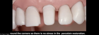 Dr. Paul A. Tipton round the corners so there is no stress in the porcelain restoration.
 