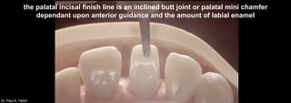 Dr. Paul A. Tipton
the palatal incisal finish line is an inclined butt joint or palatal mini chamfer
dependant upon anterior guidance and the amount of labial enamel
 