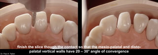 Dr. Paul A. Tipton
finish the slice though the contact so that the mesio-palatal and disto-
palatal vertical walls have 20 – 30° angle of convergence
 