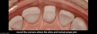 Dr. Paul A. Tipton
round the corners where the slice and incisal preps join
 
