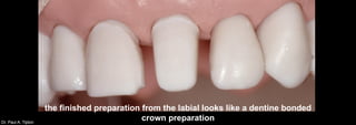 Dr. Paul A. Tipton
the finished preparation from the labial looks like a dentine bonded
crown preparation
 