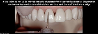 Dr. Paul A. Tipton
if the tooth is not to be moved labially or palatally the conventional labial preparation
involves 0.5mm reduction of the labial surface and 2mm off the incisal edge
 