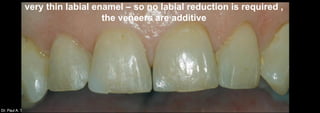 Dr. Paul A. TiptonDr. Paul A. Tipton st
very thin labial enamel – so no labial reduction is required ,
the veneers are additive
 