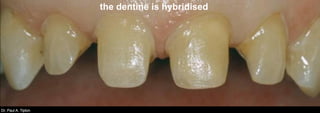 Dr. Paul A. TiptonDr. Paul A. Tipton
the dentine is hybridised
 