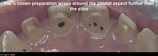Dr. Paul A. TiptonDr. Paul A. Tipton
the ¾ crown preparation wraps around the palatal aspect further than
the slice
 