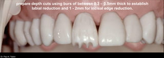 Dr. Paul A. Tipton
prepare depth cuts using burs of between 0.3 – 0.5mm thick to establish
labial reduction and 1 - 2mm for incisal edge reduction.
 